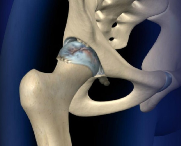 Hip Pain Comfort Injection The Hip Flexor