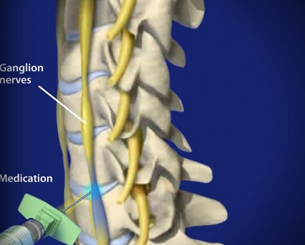 Interventional Pain & Spine Centers | Procedures that Dr. Sabiha Khadim ...